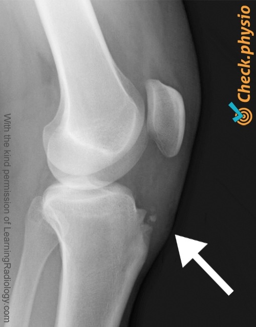 rodilla osgood schlatter radiografía