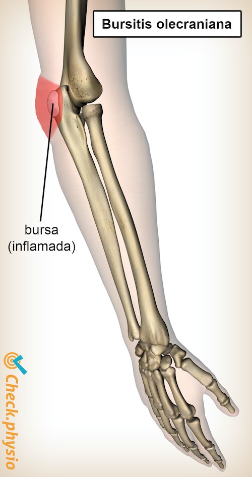 brazo bursitis del olécranon anatomía