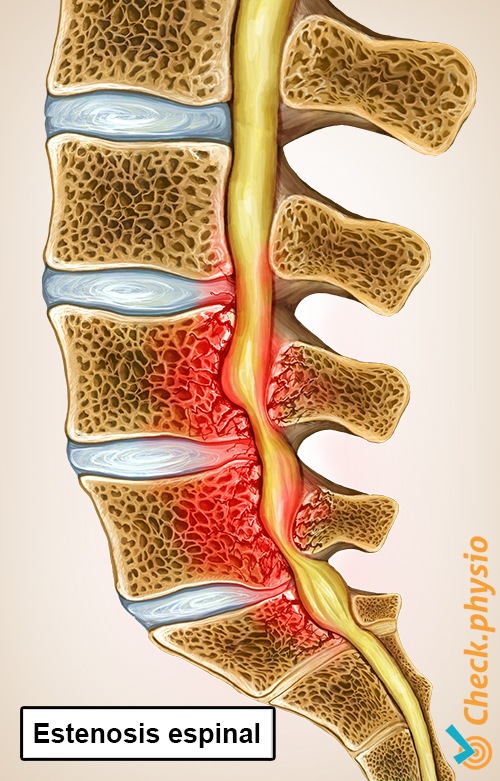 espalda anatomía de la estenosis del canal espinal sección transversal