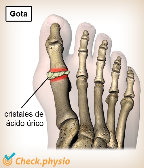 dedo del pie gota cristales de ácido úrico