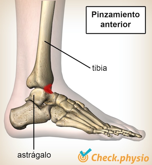 tobillo pinzamiento anterior