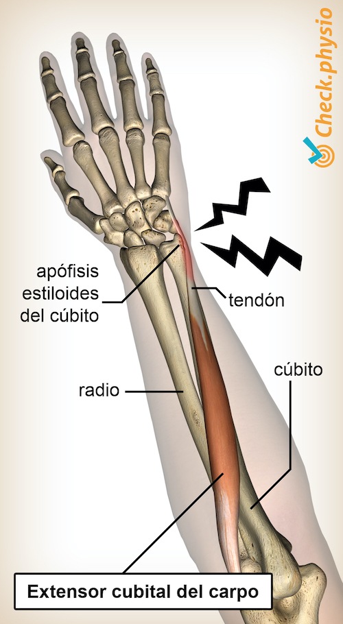 Tendinopatía del extensor cubital del carpo | Physio Check