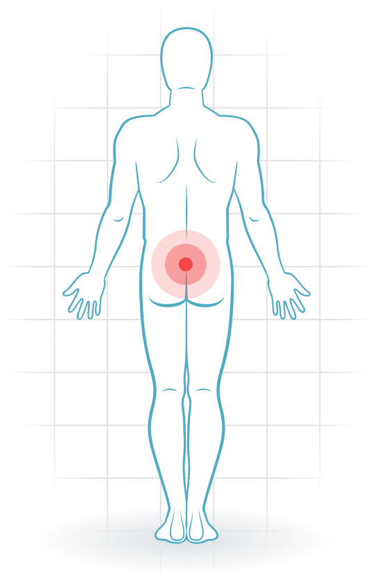 pijnlocatie Síndrome facetario lumbar