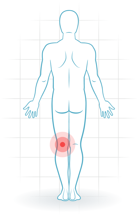 pijnlocatie Tendinitis del poplíteo